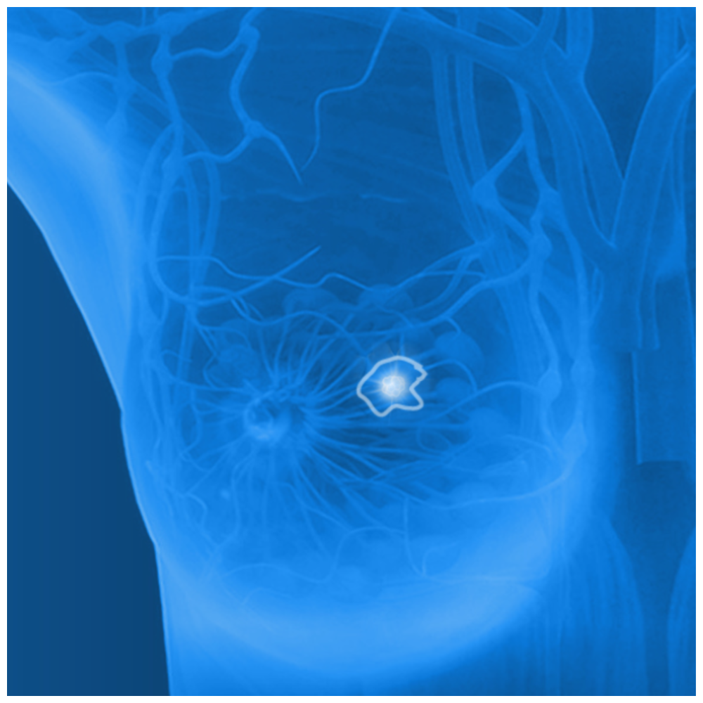 ICAD Profound AI For Digital Breast Tomosynthesis